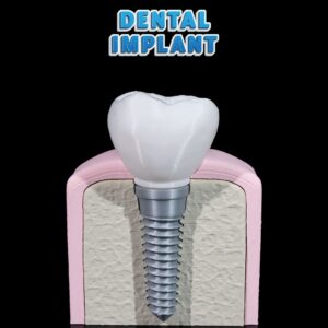 Dental Implant